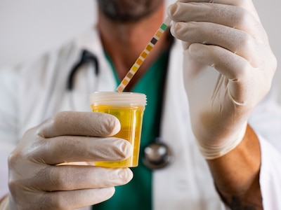 A doctor holds a urine sample and testing strip.